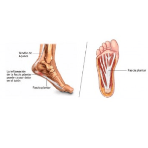 Fascitis rehab - Imagen 3